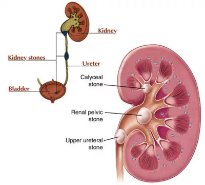 Tán sỏi qua da: Phương pháp điều trị sỏi thận
